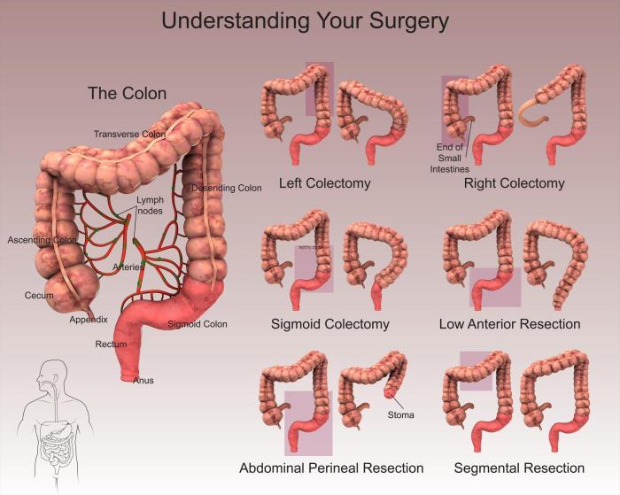 Laparoscopic right hemicolectomy cpt code