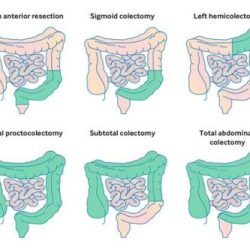 Laparoscopic right hemicolectomy cpt code