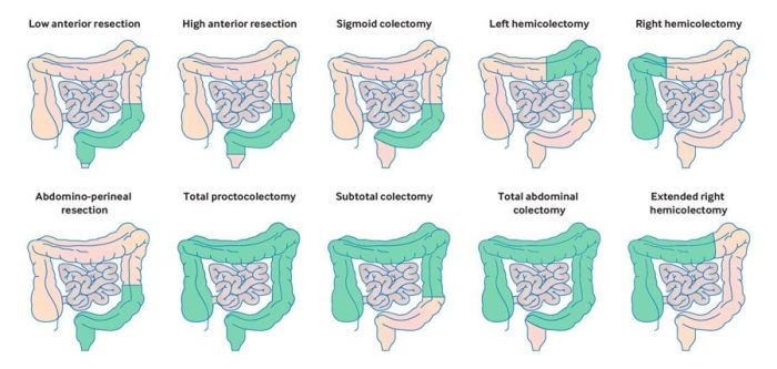 Laparoscopic right hemicolectomy cpt code